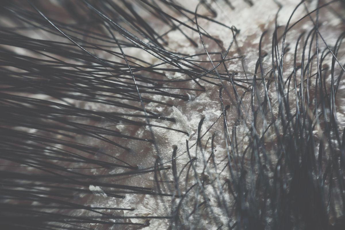Macro of hair scalp asian human with black hairline have a problem with dandruff and scaly from psoriasis because hormonal, dirty and stress.