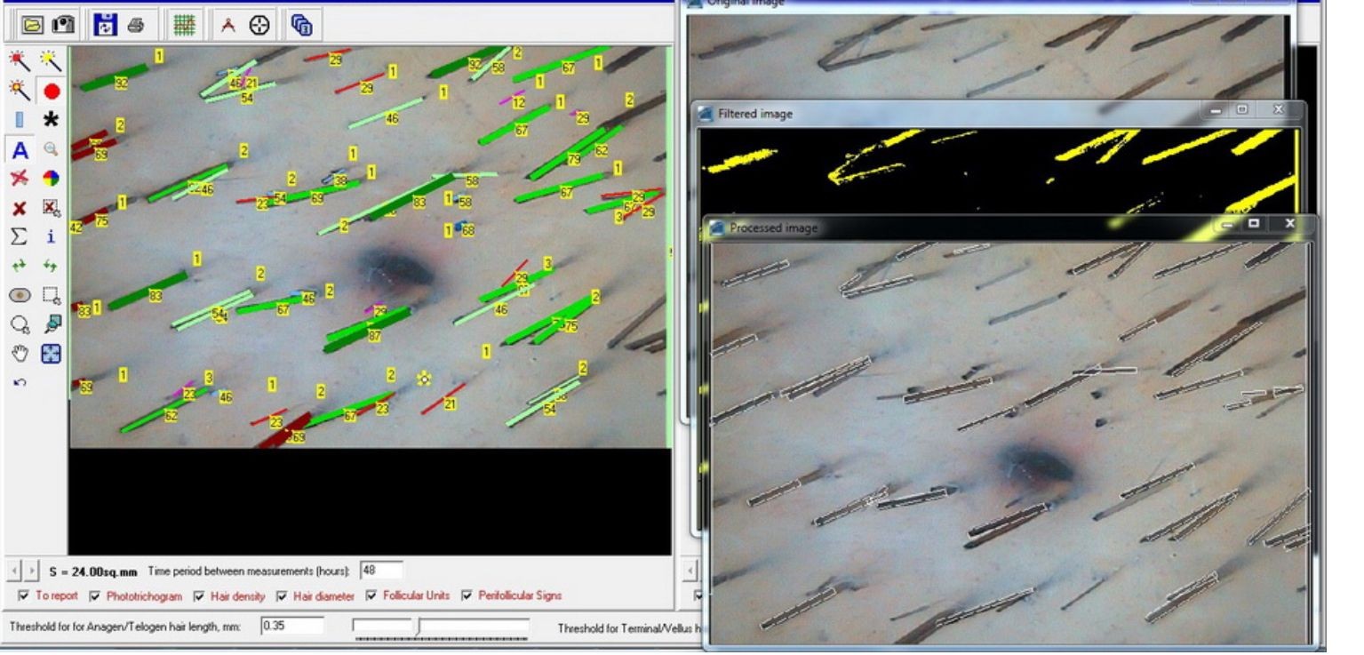 Scalp Analysis (Trichoscope Scalp Imaging) 